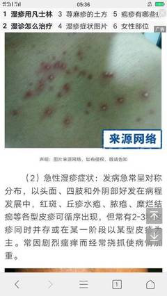 宝宝麻疹的症状和治疗