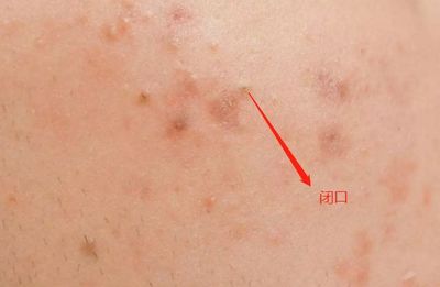 经常长闭口粉刺是什么原因