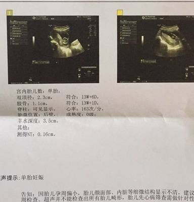 怀孕13周d二聚体多少钱