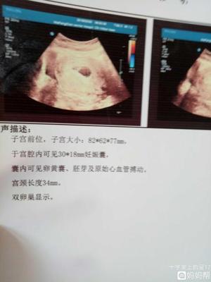 两个月胎儿图片