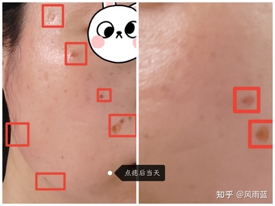 点痣不小心碰到水