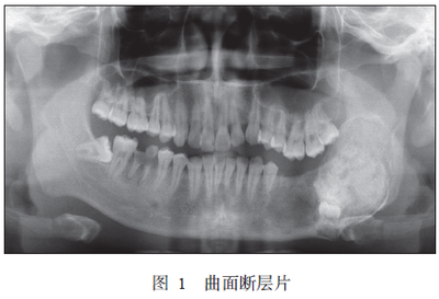 淋巴结钙化是怎么回事
