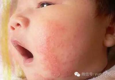 宝宝过敏起红疙瘩图片
