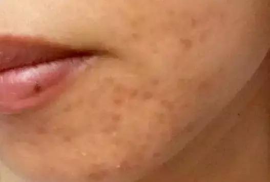 长痘痘能喝咖啡吗