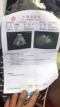 怀孕会分泌白带吗