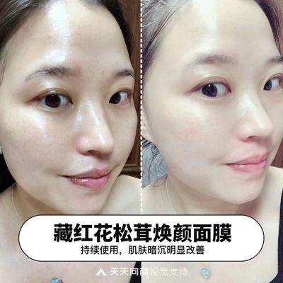 长痘痘可以敷淡斑面膜吗