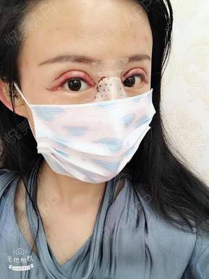 假体隆鼻眼睛周围肿了