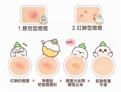 用痘痘贴是不是得挤破