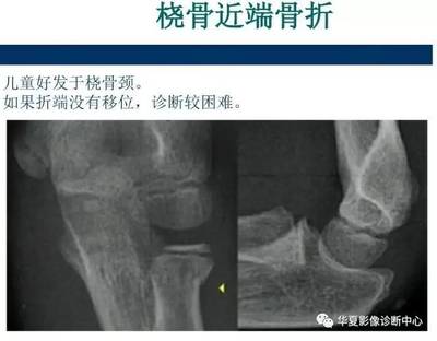 骨颈骨折后几个月能好