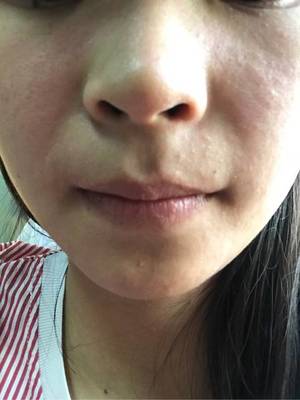 脸部发热是怎么回事