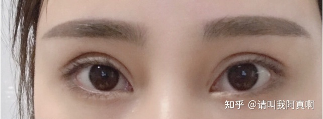 沈阳 双眼皮