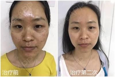 美容院能治疗痘痘吗