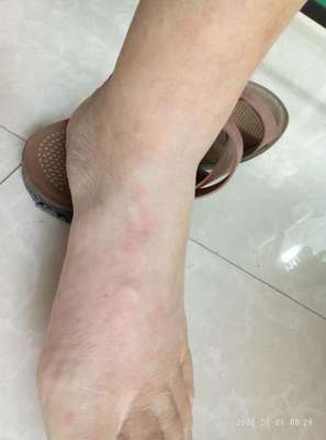 碘伏痘痘