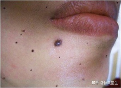 多大的痣可以用激光点