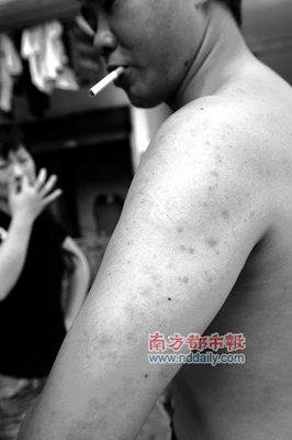 蜱虫咬人后怎么治疗