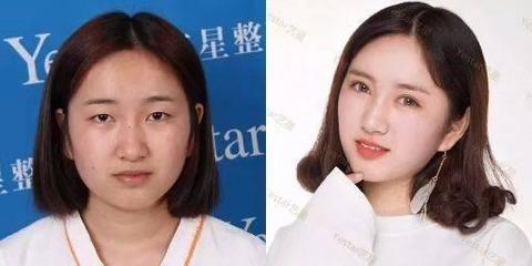 那个名星做过双眼皮