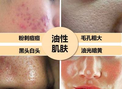 痘痘恢复后的毛孔粗大