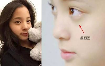 欧阳娜娜痘痘