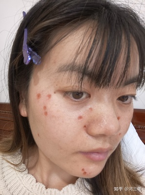 点完痣多久可以化妆