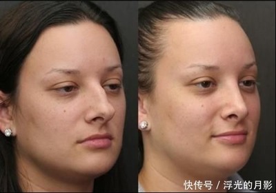 隆鼻等老了以后后遗症