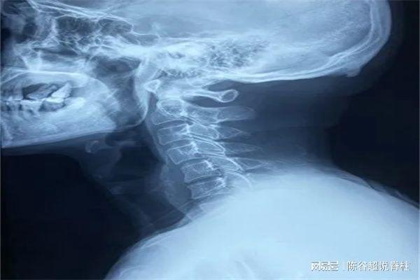 颈椎弯曲怎么治疗
