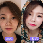 皮秒祛斑后脸上长痘