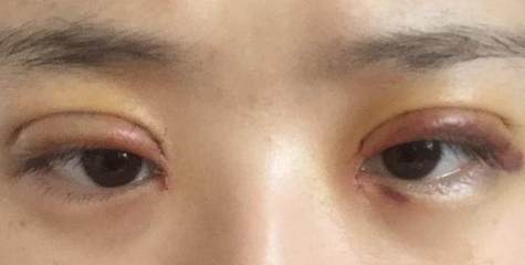 做完双眼皮有淤血怎么办