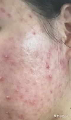 丘疹型痘痘严重么