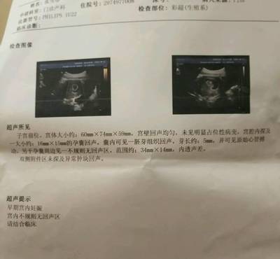 怀孕宫内有积液是怎么回事
