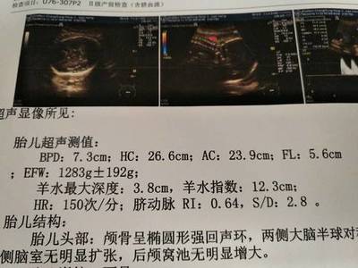 胎儿fl标准对照表
