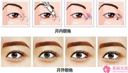 眼部整形术多少钱