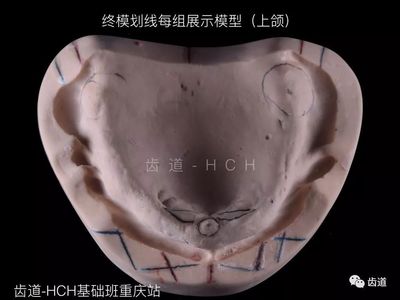 全口义齿蜡堤上下高度是多少钱