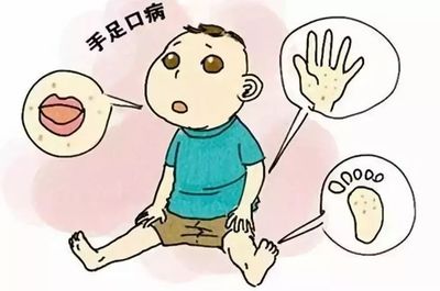 儿童手足口病怎么治疗