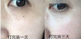 用水光针会起痘痘