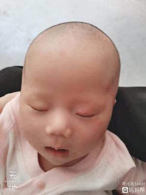 宝宝长痱子可以打疫苗吗