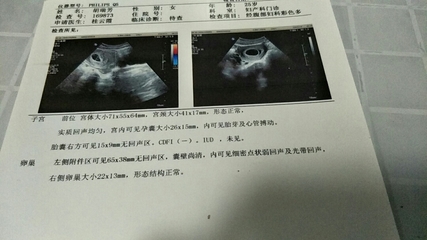 卵巢囊肿怀孕