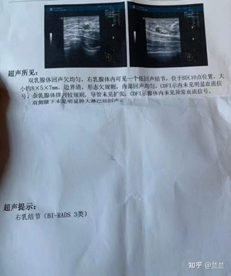 乳腺低回声结节是怎么回事
