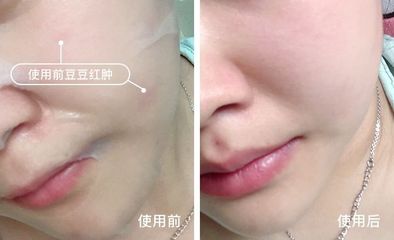 健康水 痘痘
