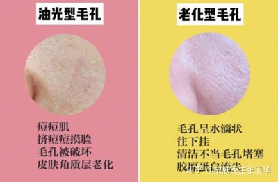 挤痘痘后毛孔粗大怎么办
