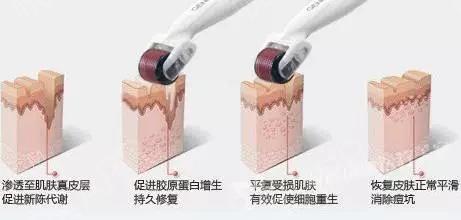 什么是微针祛痘