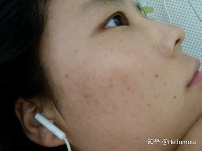 额头长闭口痘痘是什么原因