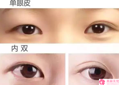 割完双眼皮后吃什么