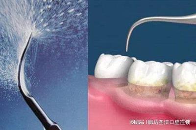 洗牙有什么作用