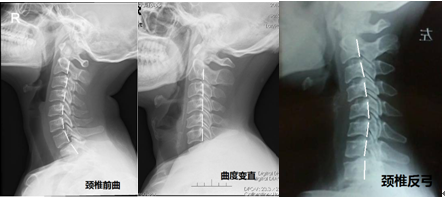 颈椎弯曲怎么治疗