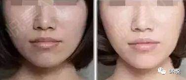 童颜针和水光针的区别