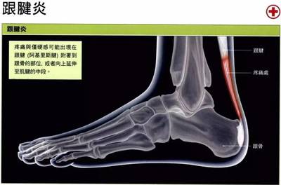 脚底板酸痛是怎么回事