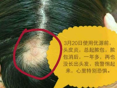 头皮炎怎么治疗