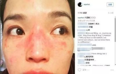 过敏脸肿了是怎么回事