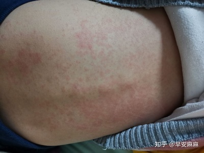 身上麻是怎么回事