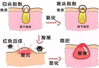 黑头粉刺怎么形成的